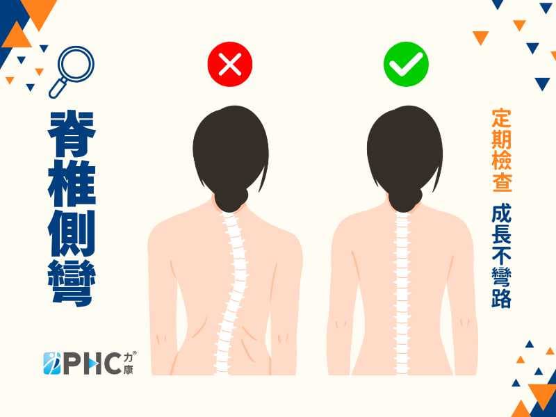 脊椎側彎 青少年以及家長要注意的事？